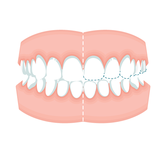Teeth ground down from bruxism