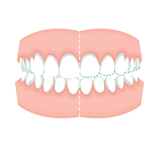 Teeth ground down from bruxism